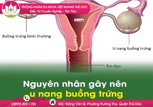 Nguyên Nhân U Nang Buồng Trứng